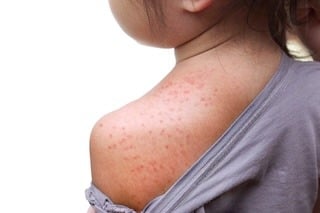 Amoxicillin Rash