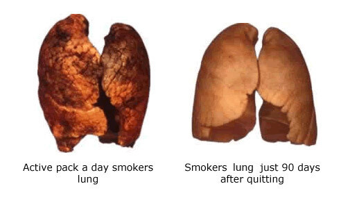 ictures_of_Lungs_After_Recently_Quitting_Smoking