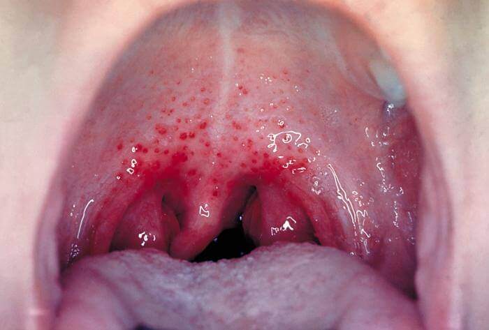 Strep_Throat_Picture (1)