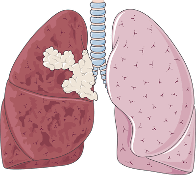 Pictures of Lungs After Quitting Smoking