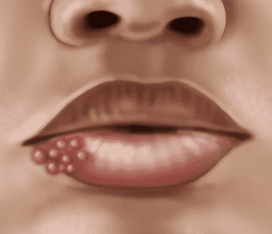 Syphillis_In_Women__ (1)